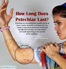 How Long Does Petechiae Last|Home Remedies To Get Rid Of Petechiae Fast