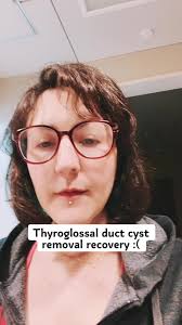 I’m hoping i’ll feel much better tomorrow. I’m avoiding my pain meds  because I’m afraid they’ll just come back up. 🫠 I wanted to make a video  since my recovery is going differently than many i have ...