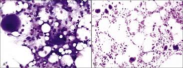 This acute form of canine leukemia usually affect dogs who are six years of age or older, but younger dogs (under 4 years of age) can also be affected. Disorders Of Bone Marrow Veterian Key