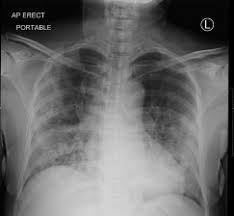 Coronavirus Disease 2019 Covid 19 Pandemic And Pregnancy American Journal Of Obstetrics Gynecology