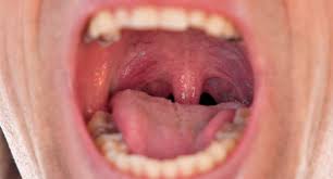 Image result for Canker sores symptoms roof of the mouth
