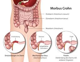 What should i do if i have an ileus? Blutiger Durchfall Ursachen Und Therapie Heilpraxis