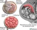 Dcollement placentaire ou hmatome en dbut de grossesse