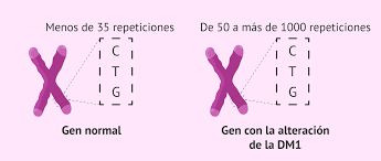 Distrofia miotónica de steinert y otras 48 miopatías congénitas: Distrofia Miotonica De Steinert Sintomas Diagnostico Y Tratamiento
