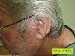 Image result for cornu cutaneum)