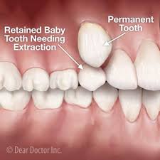 Pulling teeth, called tooth extraction by dental professionals, is not something that can be done without dental training. Removing Teeth Could Improve The Outcome For A Crowded Bite Demarco Family Dental