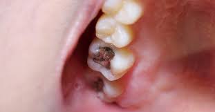 Cavities are among the most common issues in regards to dental care; Pain After Cavity Filling What You Need To Know