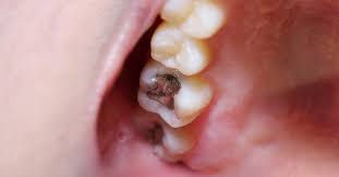 Plan to spend about an hour getting your filling to be on the safe side. Pain After Cavity Filling What You Need To Know