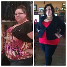 3 Months Out From Rny Gastric Bypass Rny Gastric Bypass Gastric Bypass Rny