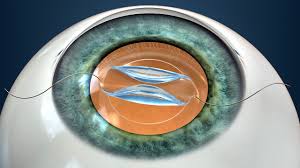 You must have someone available to drive you home after the procedure. Cataract Surgery Gavin Herbert Eye Institute Cornea Surgery Refractive Surgery Glaucoma Pediatric Ophthalmology Retina Vitreous Neuro Opthalmology Orange County California