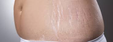 They are harmless and often fade over time. Vancouver Stretch Mark Treatments Surrey Lasers Langley White Rock Delta