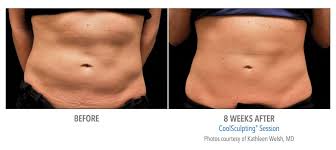 Insurance can also protect your employees if they are possibly sued by patients because of an accident involved with coolsculpting or if they are injured on the job. How Much Does A Coolsculpting Procedure Cost Find Coolsculpting Clinics