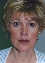 Rhinoplasty Surgery Procedure