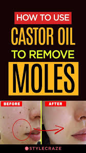 How To Use Castor Oil To Remove Moles Castor Oil Natural Hair Mask How To Remove