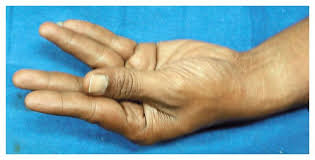 Image result for Tetany