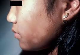 As time goes by, the spots become very dry and flaky to the extent that small raw spots of skin. How To Get Rid Of White Dry Spot On My Face Quora