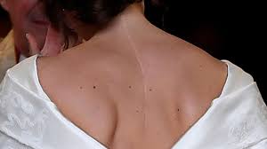 Princess Eugenie Wanted Wedding Dress To Show Scoliosis Back Scar Quartz