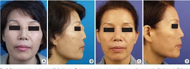 Figure 1 from Foreign Body Inclusion Cyst of the Nasal Radix after  Augmentation Rhinoplasty