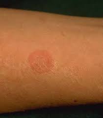 Ringworm Rabbits Vetlexicon Lapis From Vetstream Definitive Veterinary Intelligence This condition originates because of a fungal infection and not by worms. ringworm rabbits vetlexicon lapis