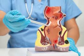 Image result for Perianal Abscess