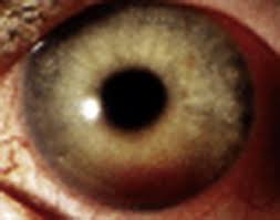Image result for Hyphema