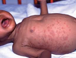 Image result for skin rash acute hiv infection