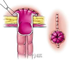 Modern living room tables images and appendices epiploicae function. Intestinal Stomas Historical Overview Springerlink