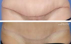 Pin On Dealing With Surgery Scars