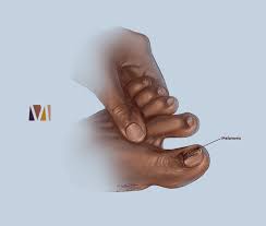 Image result for Acral lentiginous melanoma nail