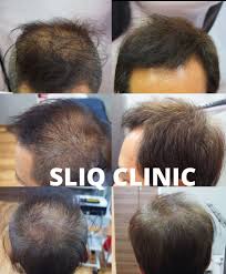 Facebook messenger monday to friday: Natural Hair Loss Treatment In Kl Pj Sliq Clinic