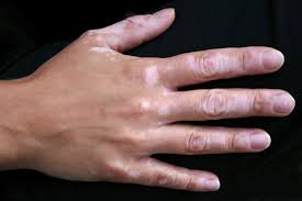 Bebeklerde Vitiligo Neden Olur Vitiligo Nasil Anlasilir Vitiligo Kalici Midir Vitiligo Genetik Mi Hastalik Tedavisi Wiki Kadinlar Kulubu