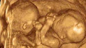 Entwicklung Zwillinge Im 6 Monat Ssw 22 Ssw 25 Babywelten Ch