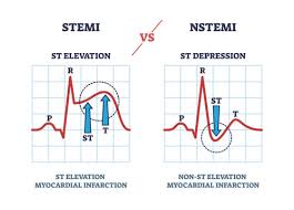 Image result for ST Segment