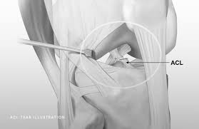 A few key points to remember understanding why a torn acl is not really good at healing on its own rests on several basic anatomy concepts. Acl Injuries Chicago Il Jorge Chahla Md