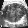 Più dell'80% dei casi di cancro al seno si verifica, infatti, nelle donne sopra i 50 anni. 1