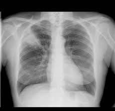 Fracture Des Cotes Symptomes Traitement Definition Docteurclic Com