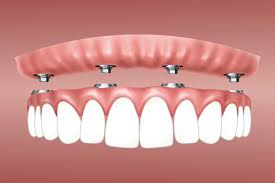 All On 4 Dental Implants Vs Dentures | Radiance Dental