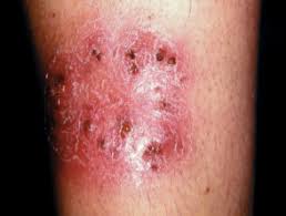 Most of the studies in the treatment of. Tinea Corporis Dermnet Nz