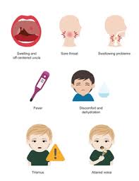 Image result for Peritonsillar Abscess