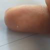 However, some experts may take a sample of hair to determine the anagen to telogen ratio of hair growth cycle. 3