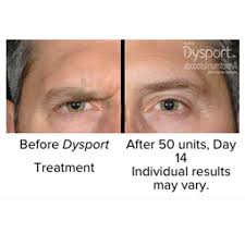 Dysport temporarily relaxes targeted muscles to prevent the muscle movements that cause wrinkles. Dysport By The Unit About Face Kailua Hi