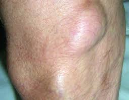 Lipome Erkrankungen Der Haut Msd Manual Profi Ausgabe