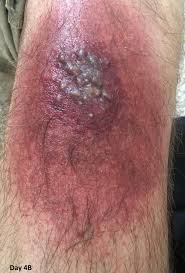 Image result for wolf spider bite skin