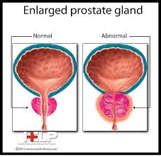 Enlarged Prostate Gland Enlarged Prostate Prostate Prostate Health