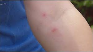 Image result for mite bites on humans