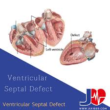 Image result for Ventricular Septal Defect