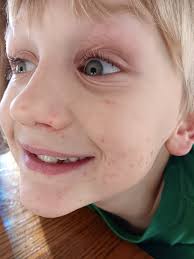 After struggling with SIBO and major GI issues, I finally addressed the  root cause and began my healing journey four months ago. With a strict  gluten free, dairy free, and sugar free