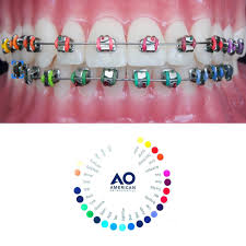 Black And Navy Blue Braces American Orthodontics Braces Colours Orthodontics Braces Colors Braces App
