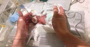 After Spending Months In The Hospital The World S Smallest Surviving Premature Baby Has Been Finally Sent Home Artfido