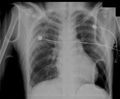 Image result for Small Caliber Chest Tube